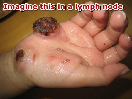 Hand with histiocytosis of the skin